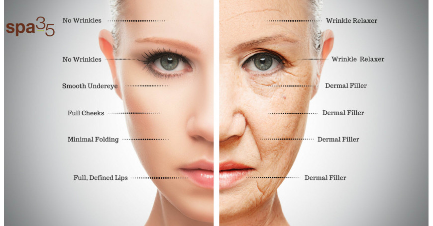 Botox vs. filler dermici: qual è la differenza?