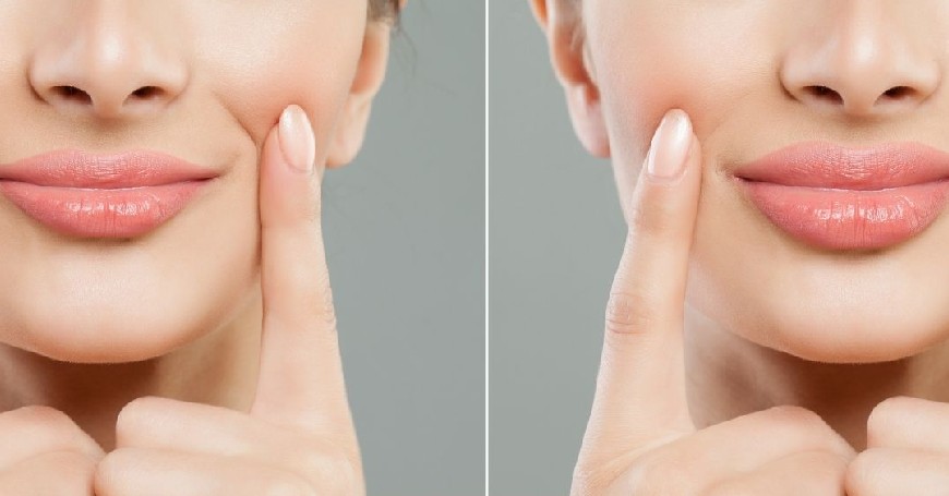durata effetto filler labbra prima e dopo